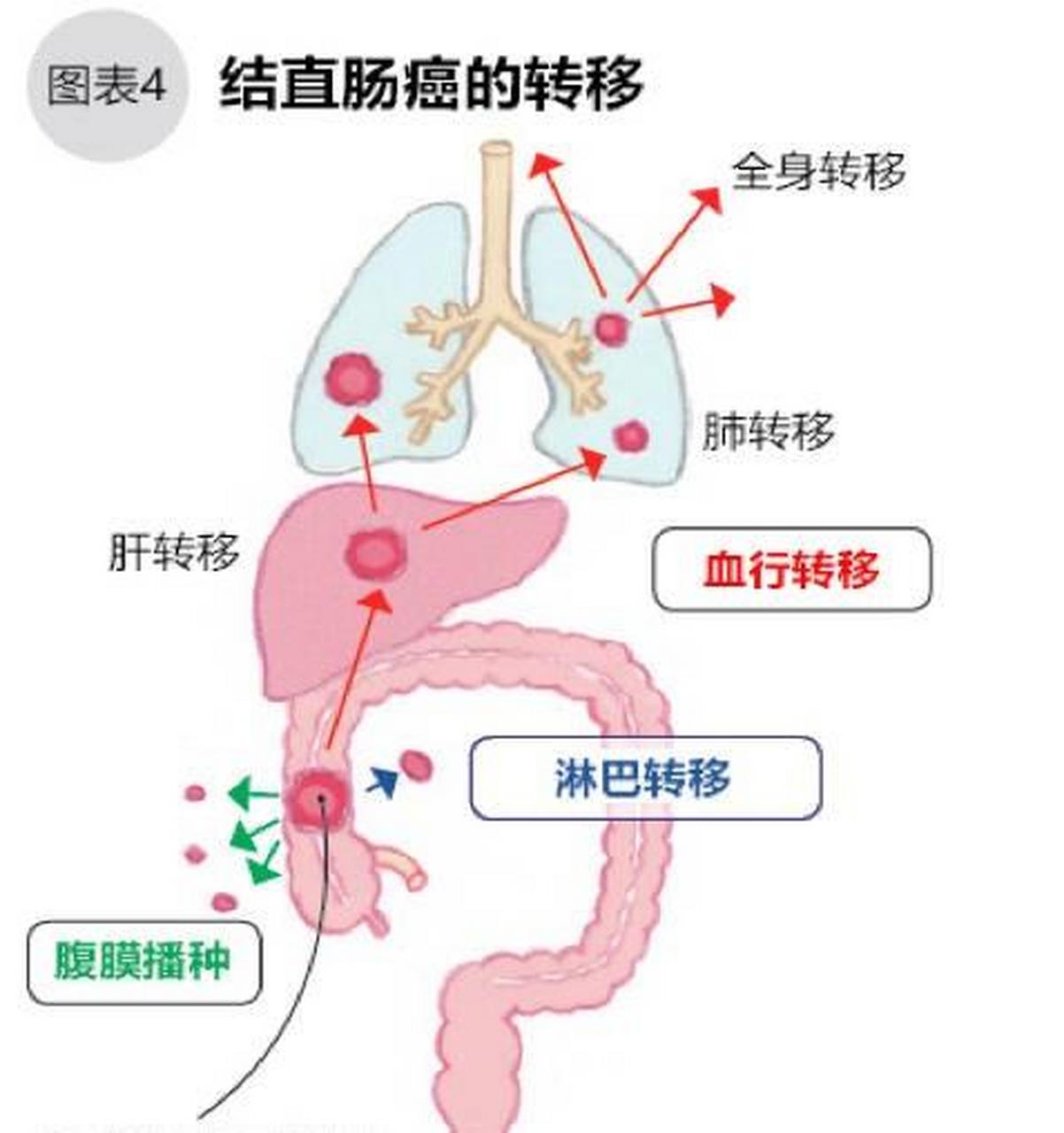 结直肠癌腹膜转移,是结直肠癌病变进程中,一种特殊且严重的病情,也是