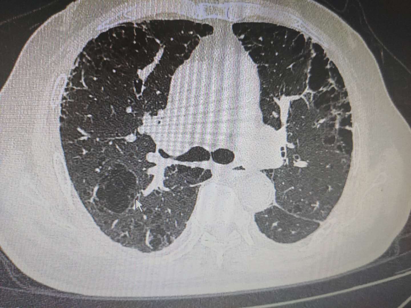 ct上满肺都是大泡泡,原因居然和吸烟有关