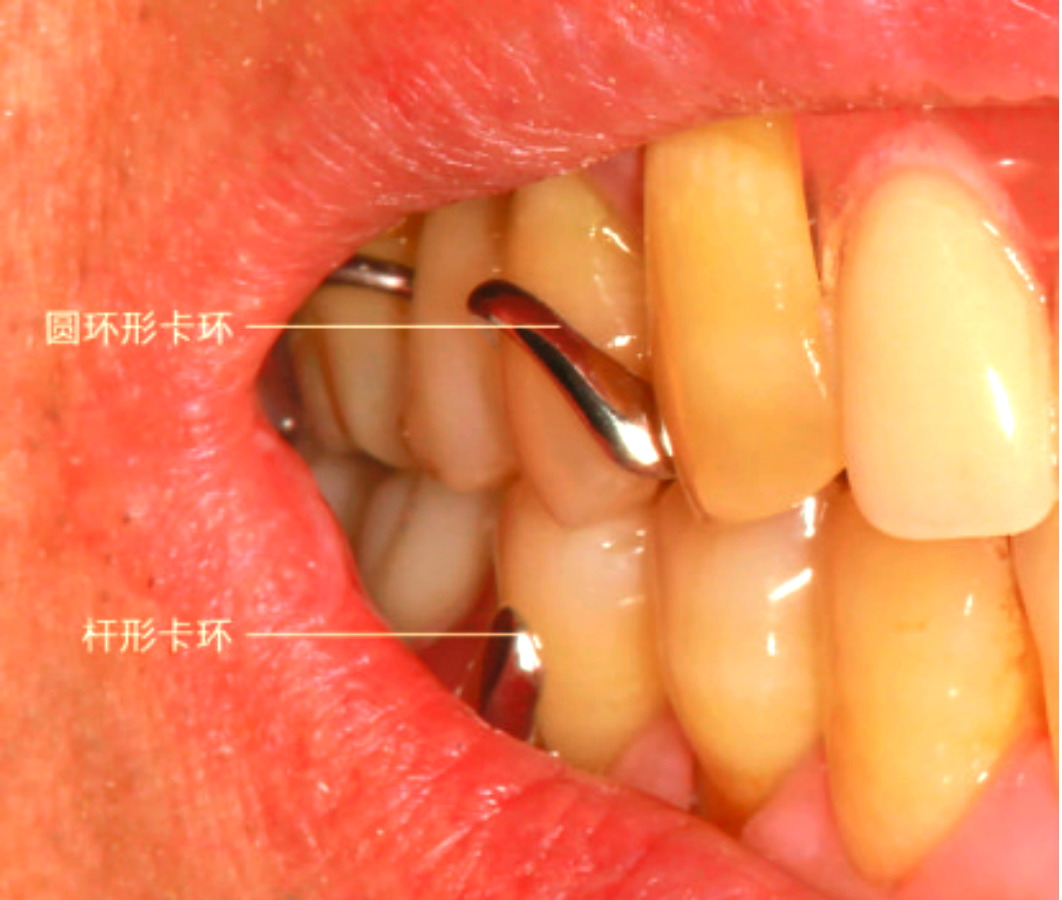 可摘局部义齿卡环的设计与应用详解