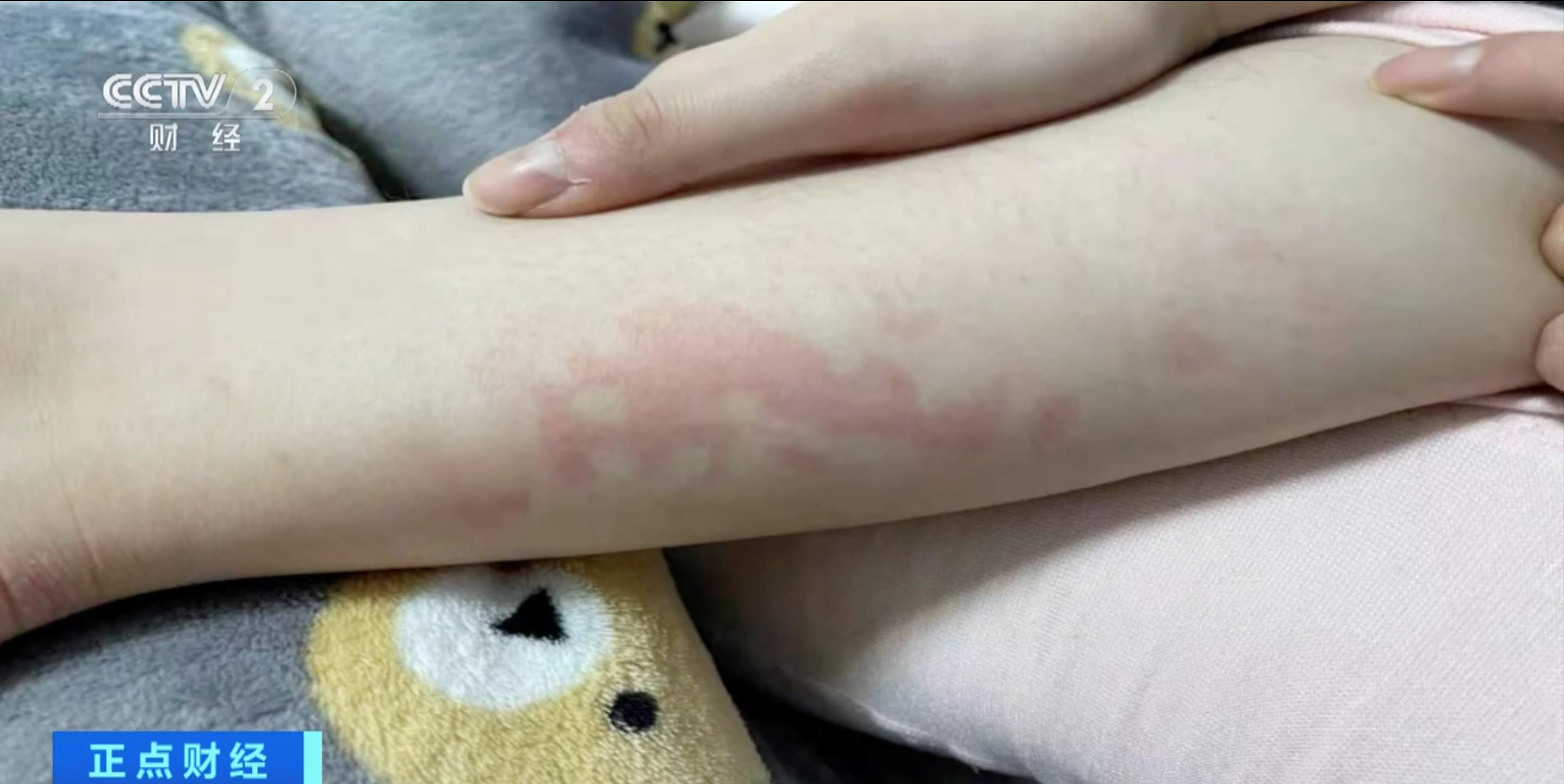 冬季警惕发生低温烫伤!医生提醒:不要通宵使用电热毯