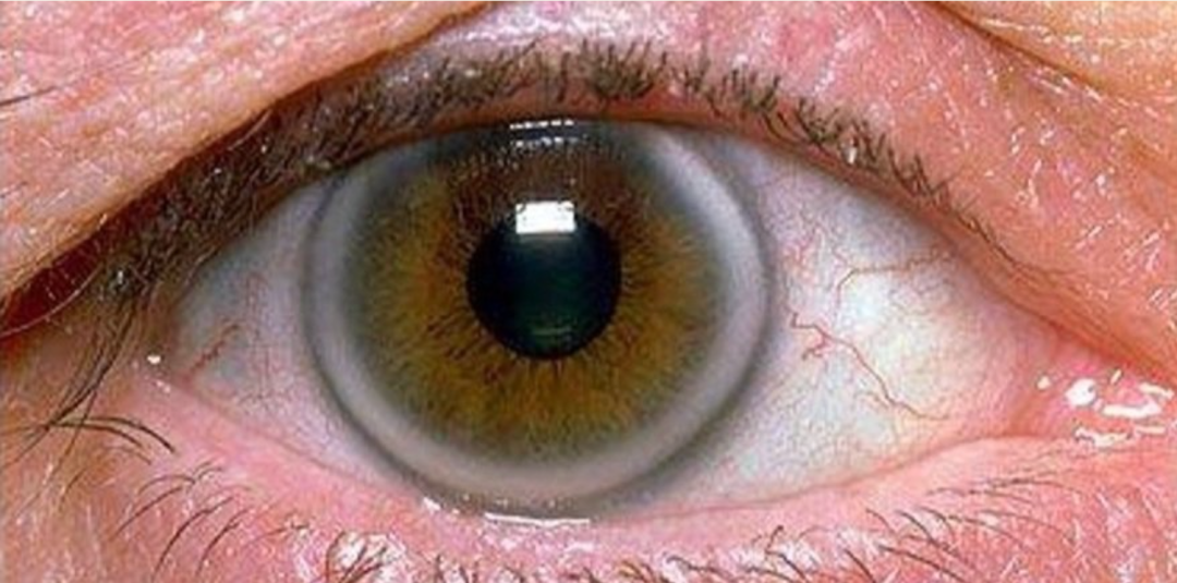 从自己的外表能看出来血脂高不高是真的