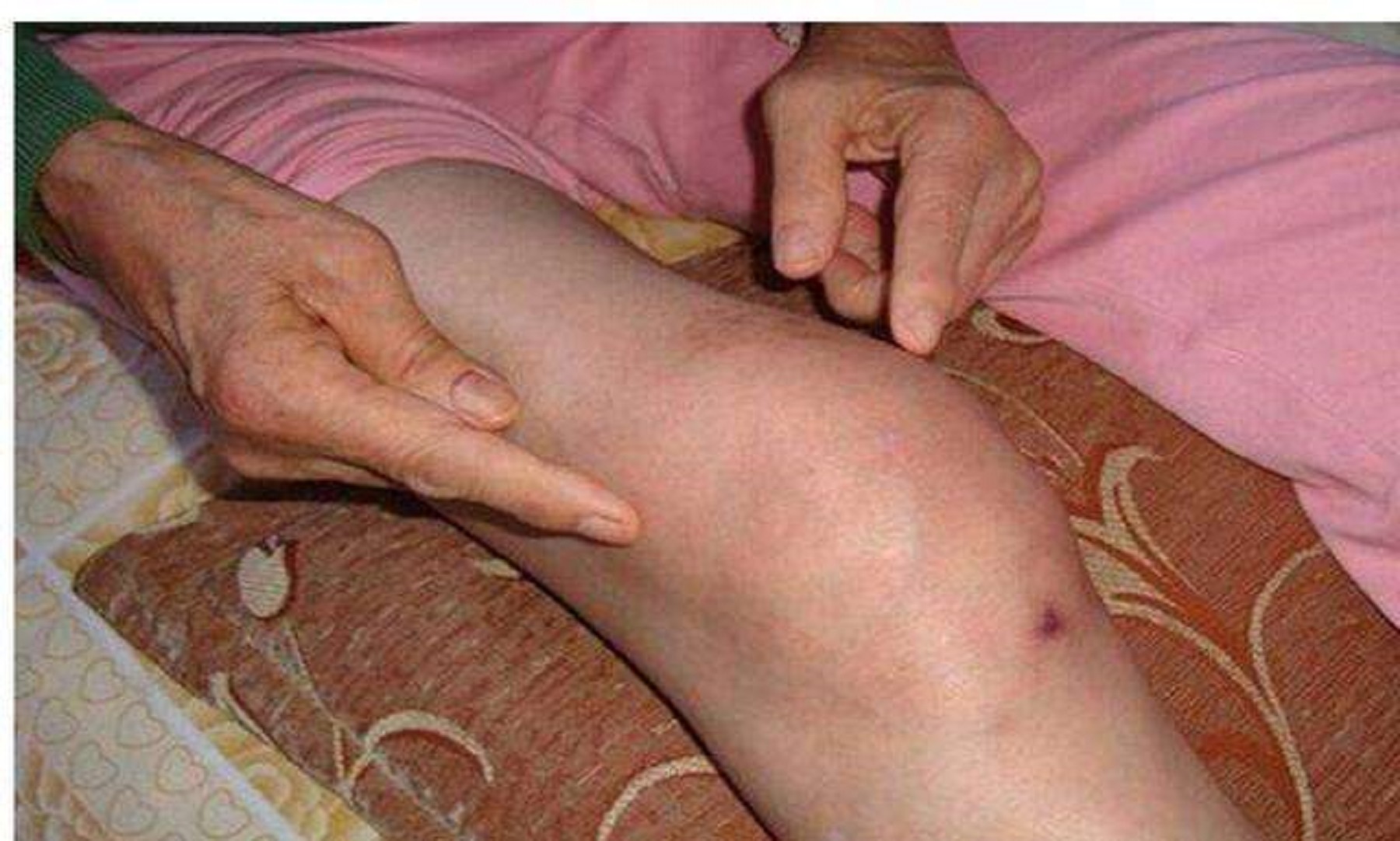 膝盖疼痛,走路困难是风湿性关节炎发作?几个妙招帮你轻松治愈!