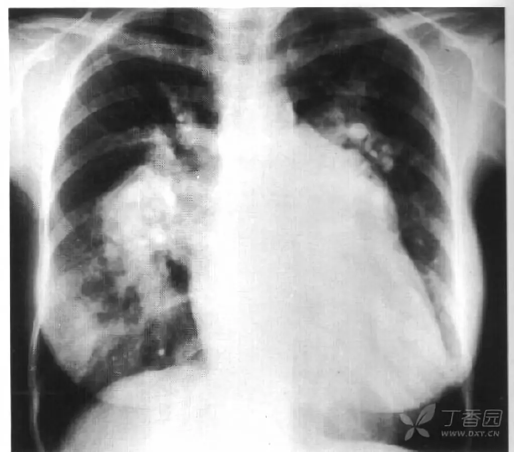 肺动脉高压胸片表现图片