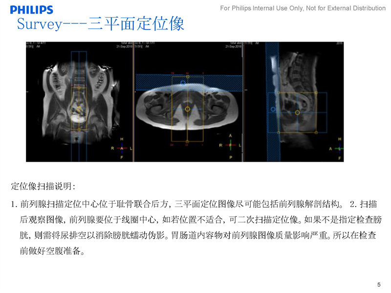 前列腺磁共振正常图像图片