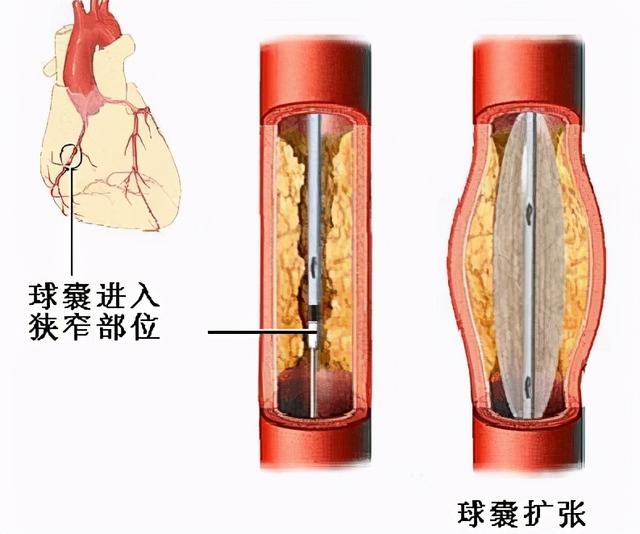 冠状动脉球囊扩张图片