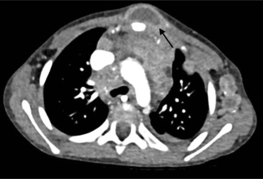 胸壁肿物(胸骨结核,胸壁结核)