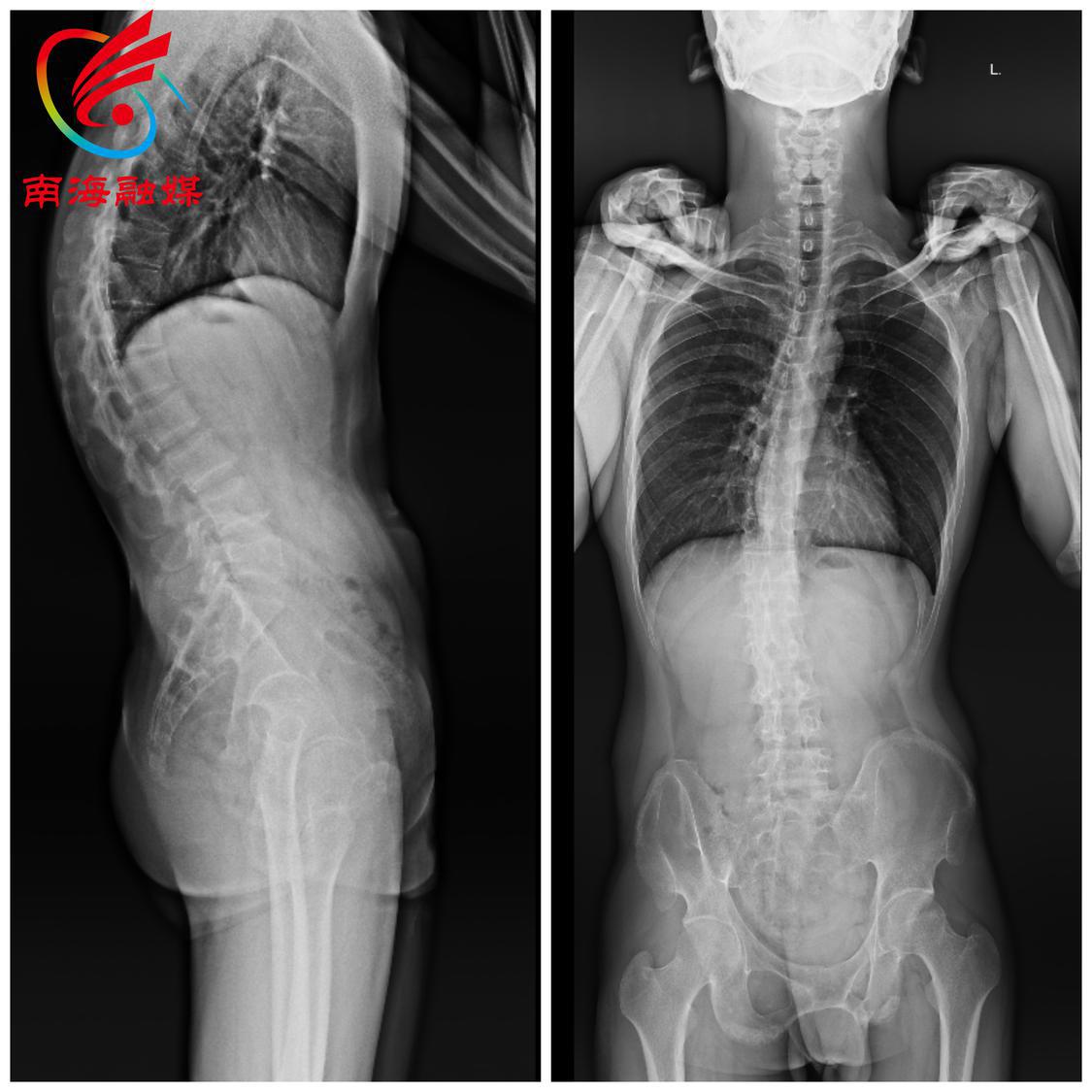 "长高"7厘米!强直性脊柱炎胸椎后凸畸形"高才生"在南方七院"挺直脊梁"