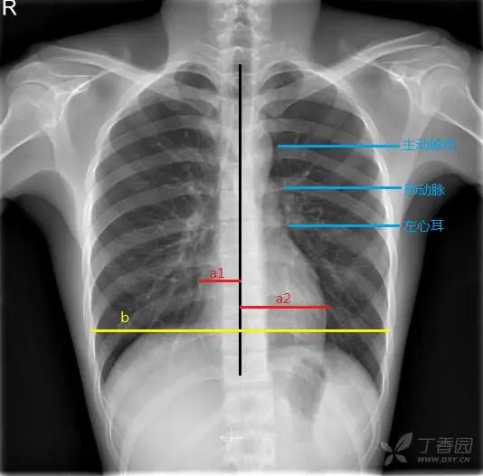 影像医生最需警惕的异常胸片征象(附22个胸片中常见的影像征象)