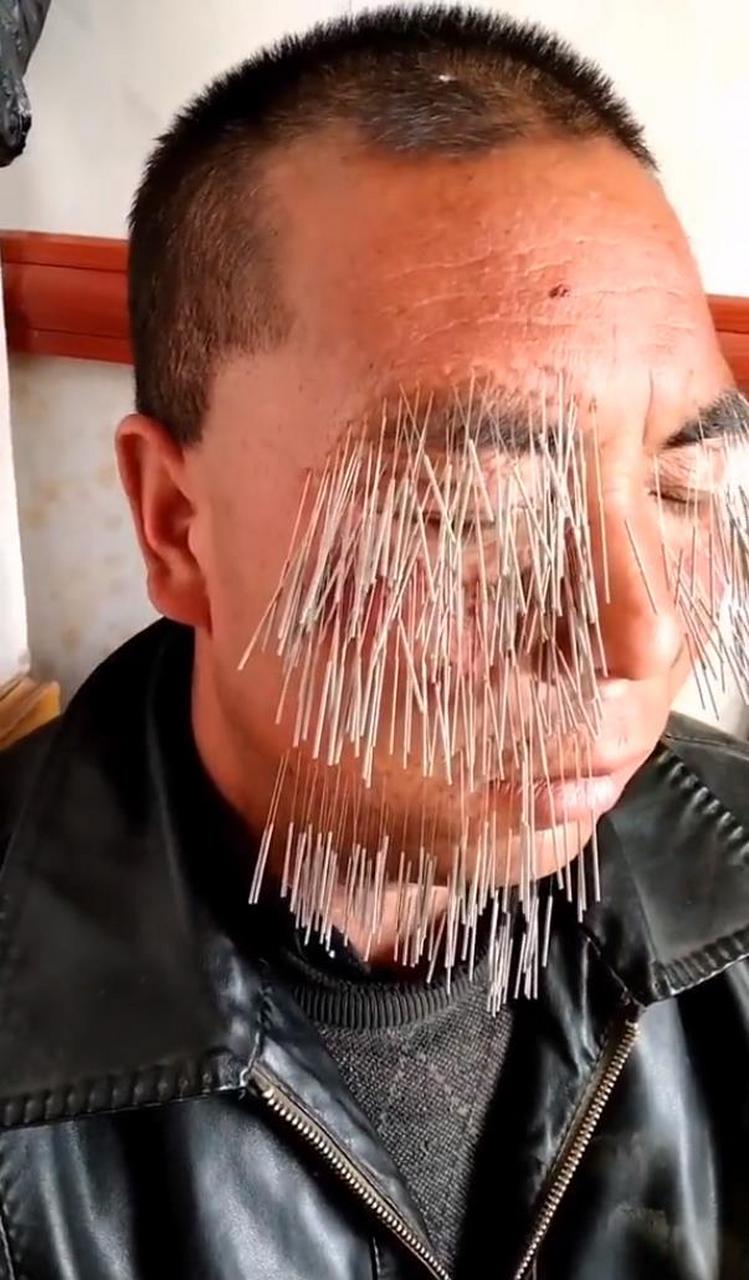扎针的最高境针,总有一针是扎对扎.
