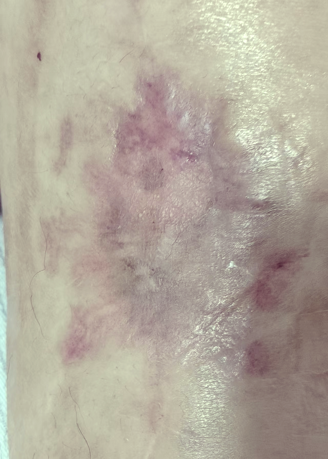 伤口愈合难题?综合治疗管理助您解决