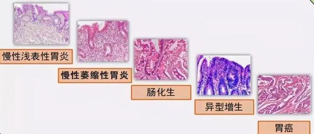 患有慢性淺表性胃炎,久治不愈怎麼辦?關鍵是治療方法要用對