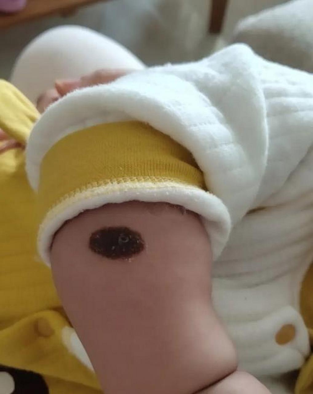 4种情况需警惕黑痣癌变#  身上的痣出现这4种情况,有癌变的风险!