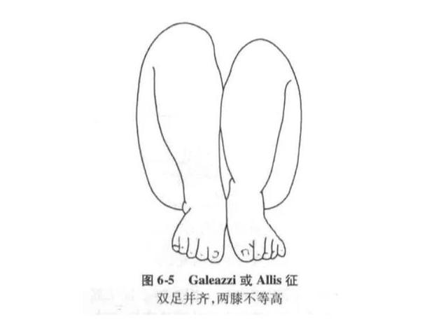 宝宝长短腿,家长警惕这个病