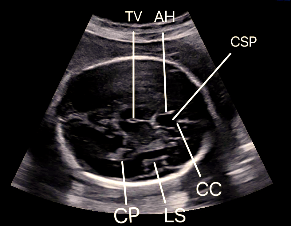 胎儿透明隔腔的超声学习与了解