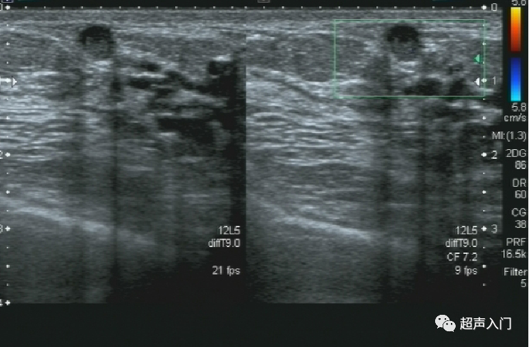 「病例分享」乳腺导管原位癌超声诊断一例