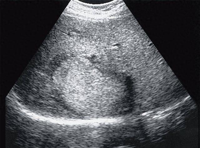 肝多发囊肿,最大6.5x5.1cm!病在肝郁脾虚