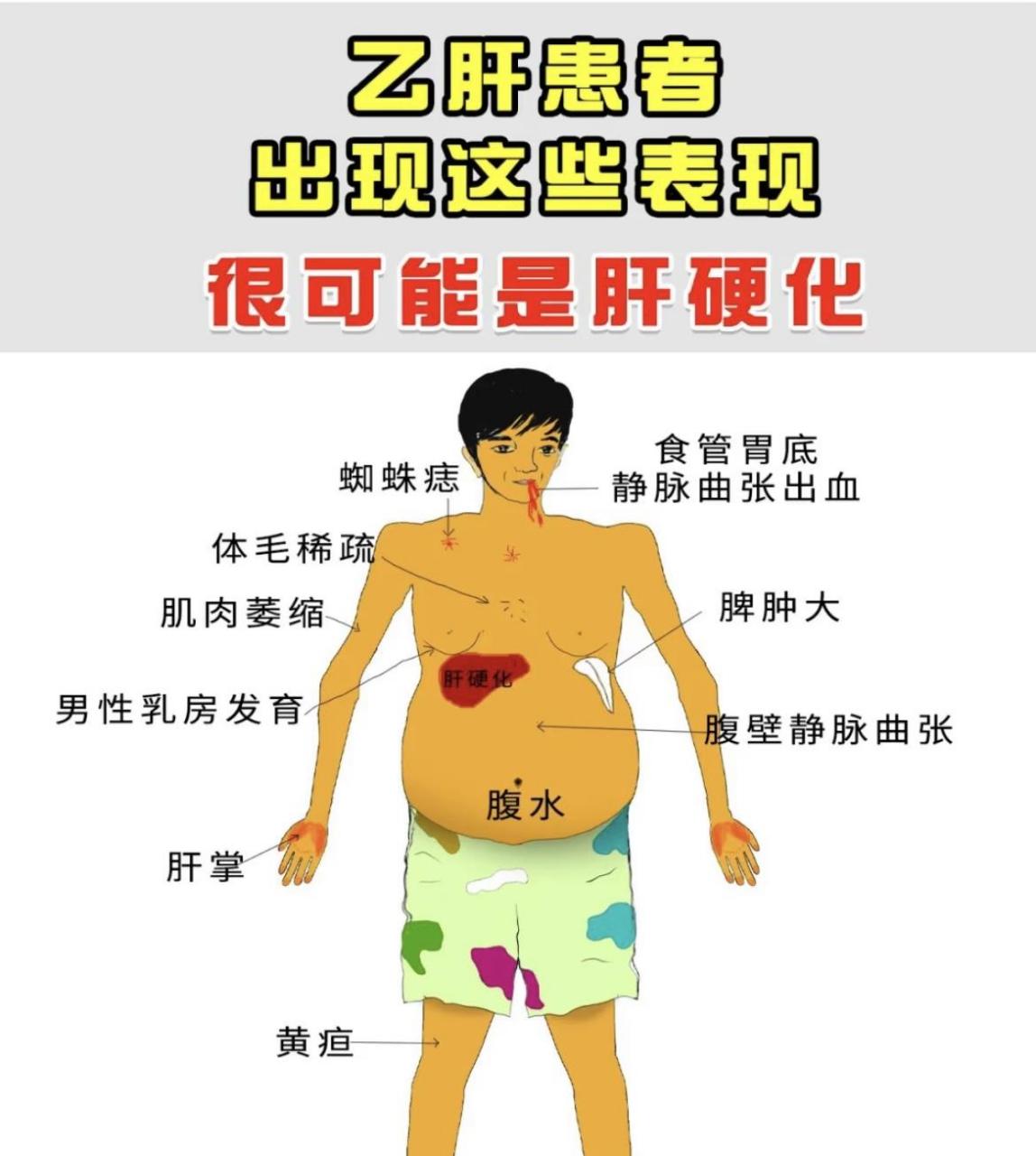 肝硬化都有哪些症状?