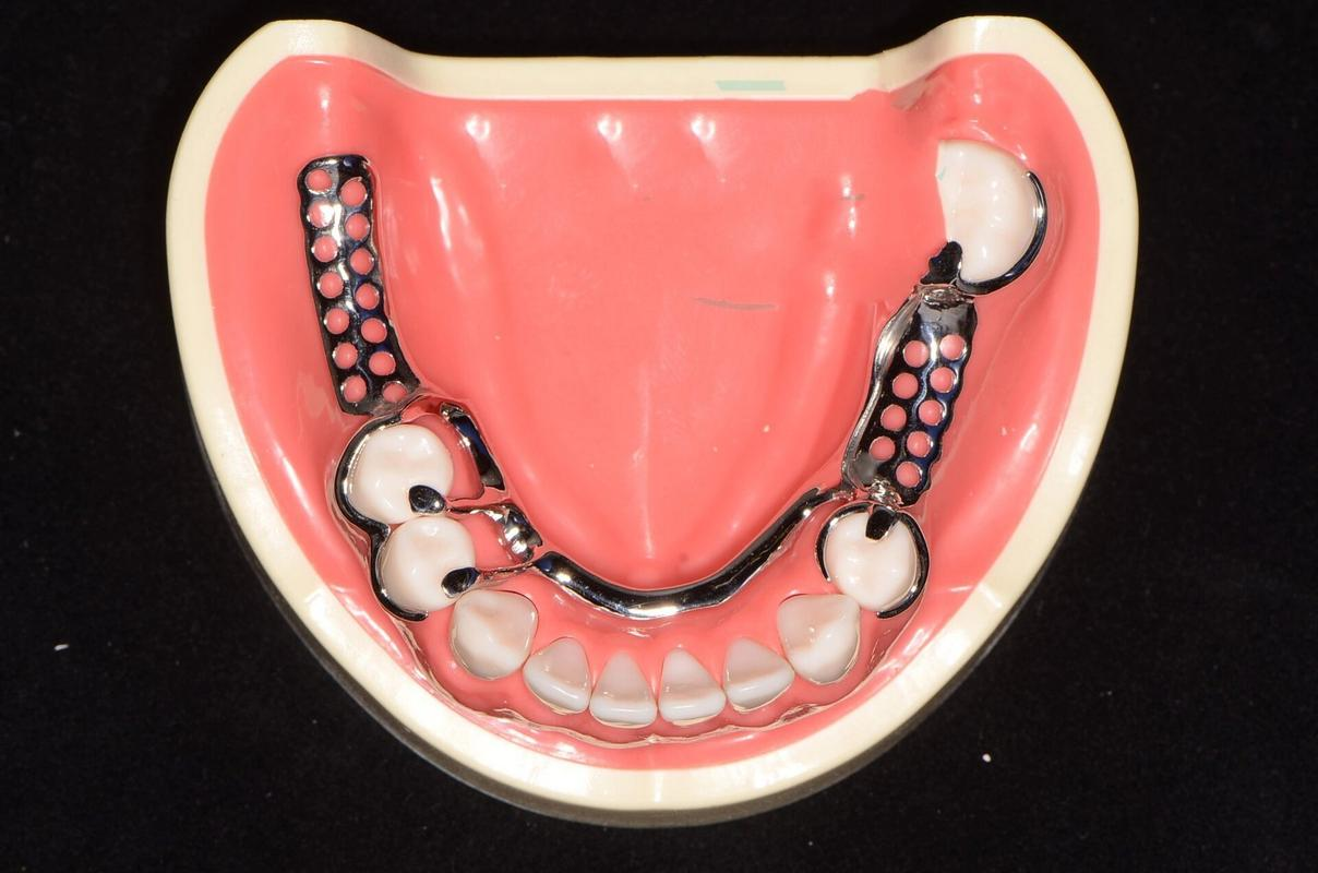 可摘局部义齿固位设计:原则,分类及优化解析