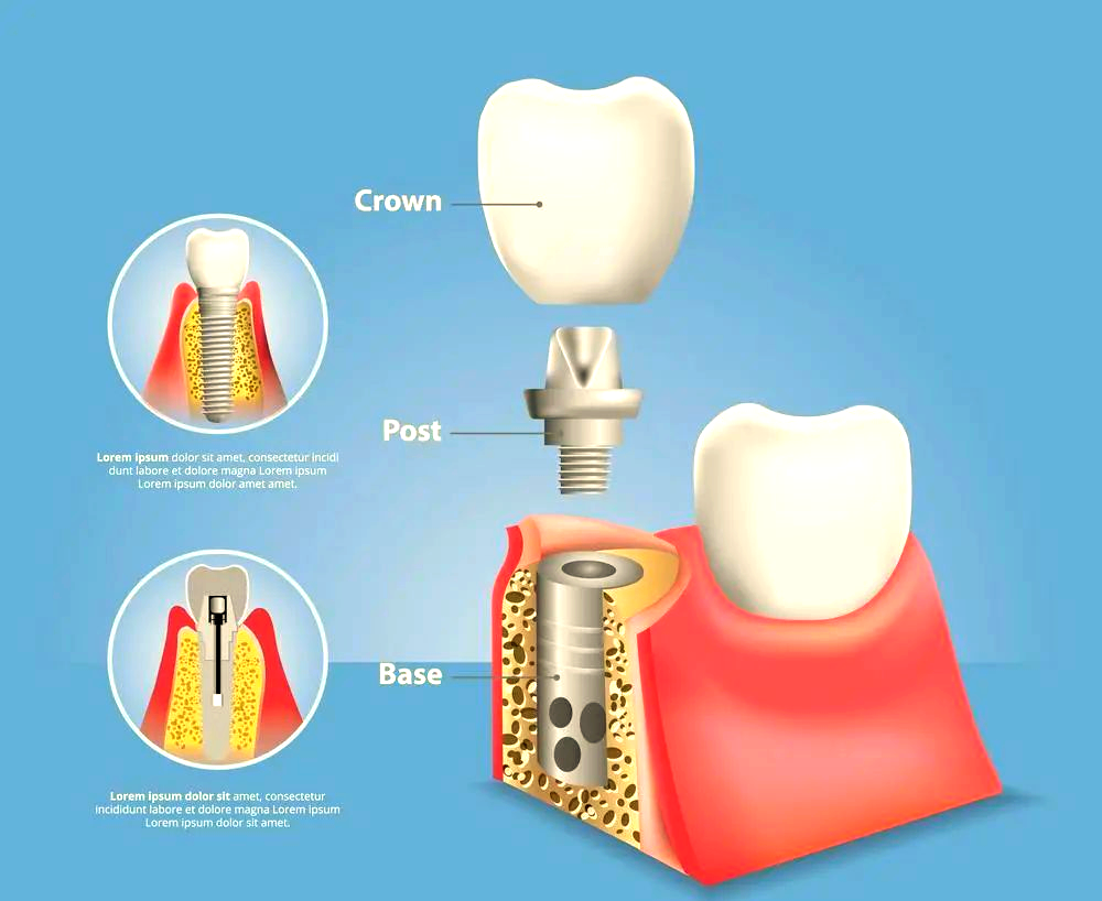 种植牙基台的种类与选择指南