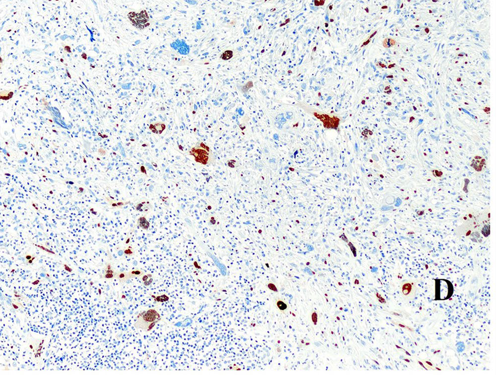 头颈部病理十大-促纤维增生性恶性黑色素瘤十大鉴别(二)