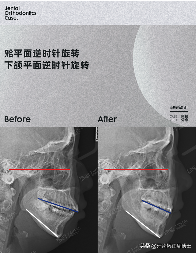 轻度双颌前突图片图片