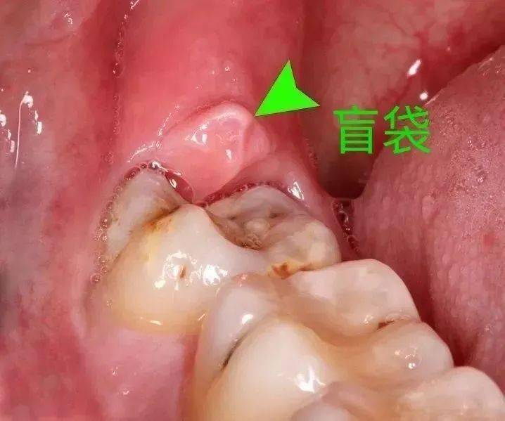 智齿发炎了肿胀疼痛?牙医告诉你在家这4个急救办法消炎止痛