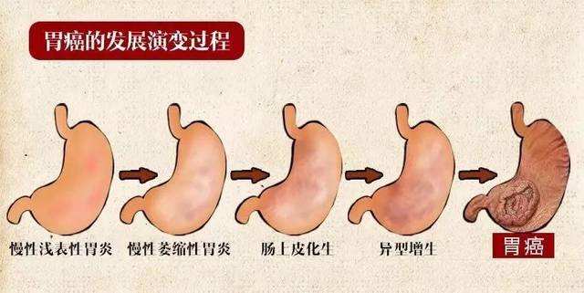 胃癌是怎么形成的图片