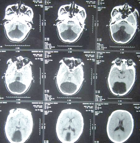 大枕大池及其鉴别诊断详解