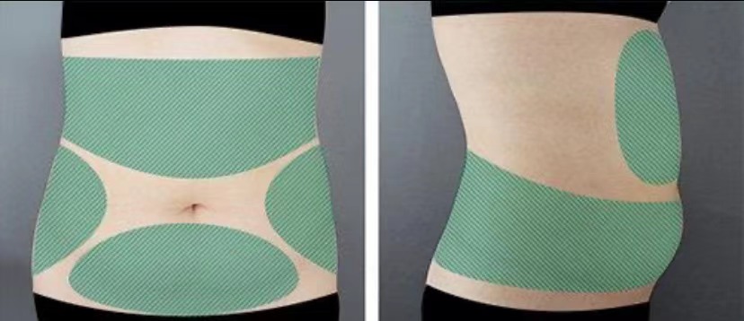 吸脂干货:腰腹环吸是哪几个部位?包括哪些?有妈妈臀吗?