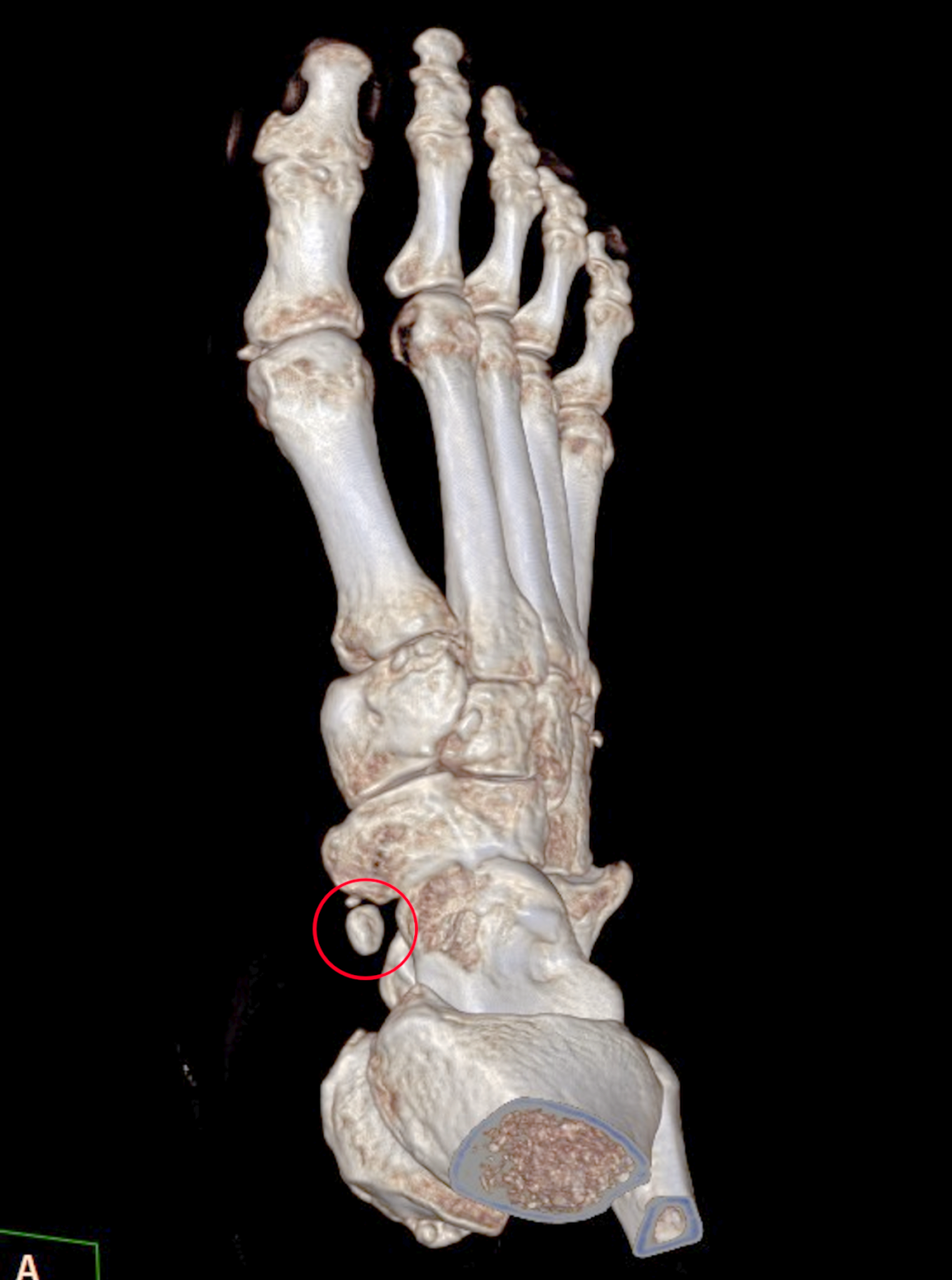 足踝门诊中常见的疼痛问题,但大众往往认识不足