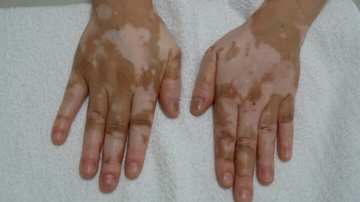 阜阳皮肤病医院治疗白癜风,选对方法是关键