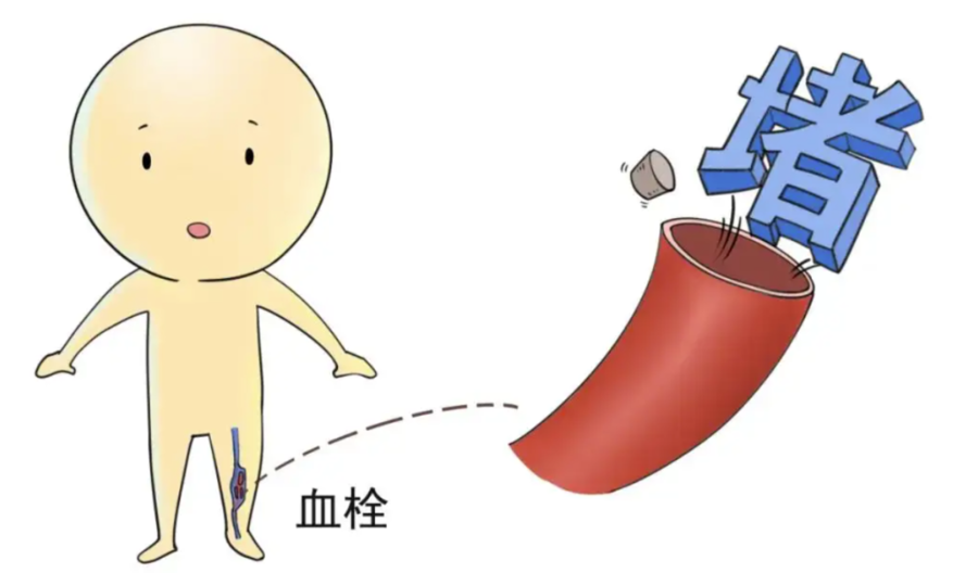 关于儿童静脉血栓,你了解多少?
