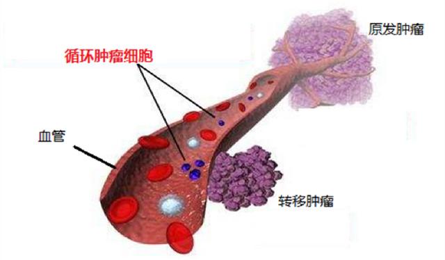 循环肿瘤细胞:助力肿瘤早发现,早治疗