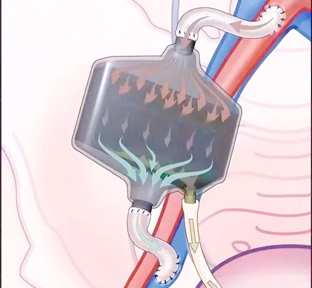 植入式人工肾:开启自由生活的未来