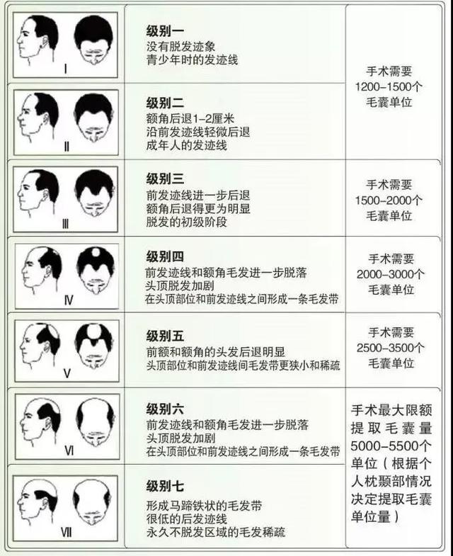 脱发的几种类型图片图片