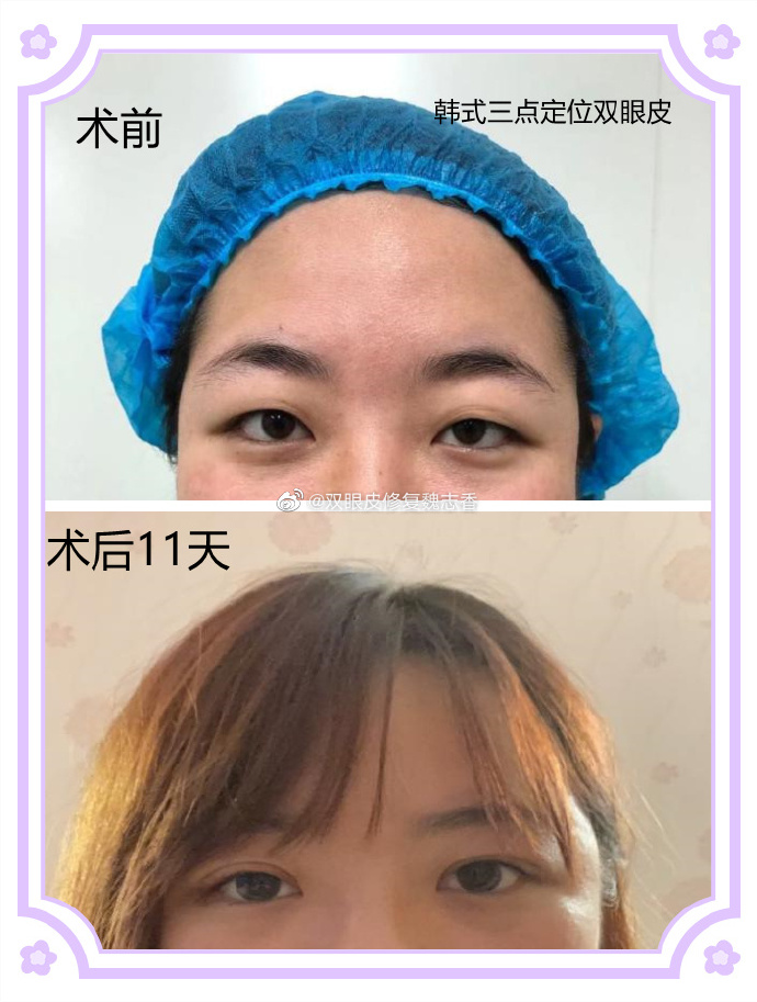 韩式三点定位双眼皮需要拆线吗?