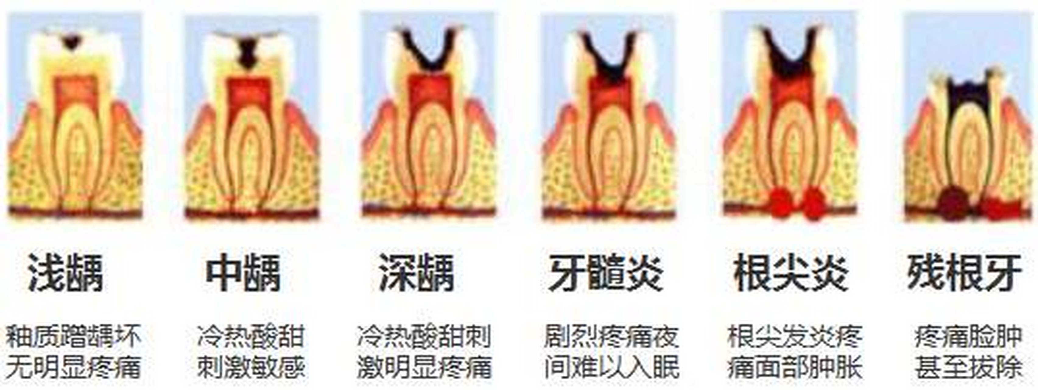 什么是急性牙髓炎?