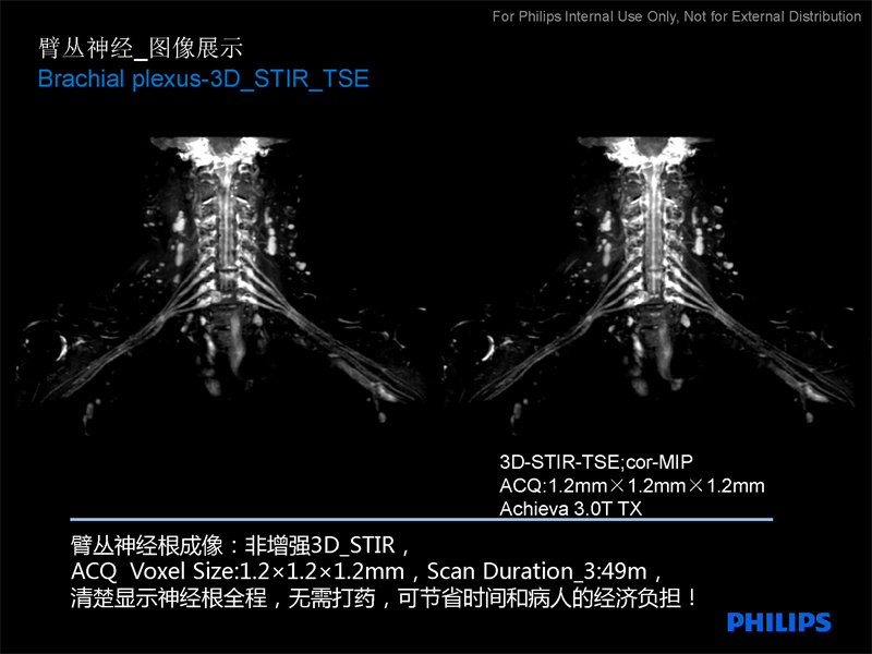 臂丛神经扫描方案|磁共振规范化扫描方案|飞利浦