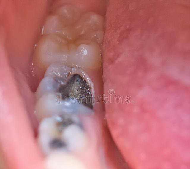 一起来看看拔牙后窟窿恢复图