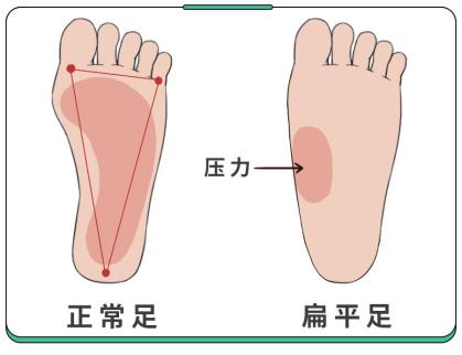 小孩扁平足图片 判断图片