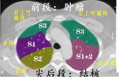 肺结核ct图片图解图片