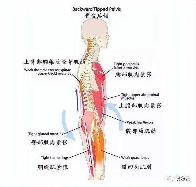 骨盆后倾的危害图片