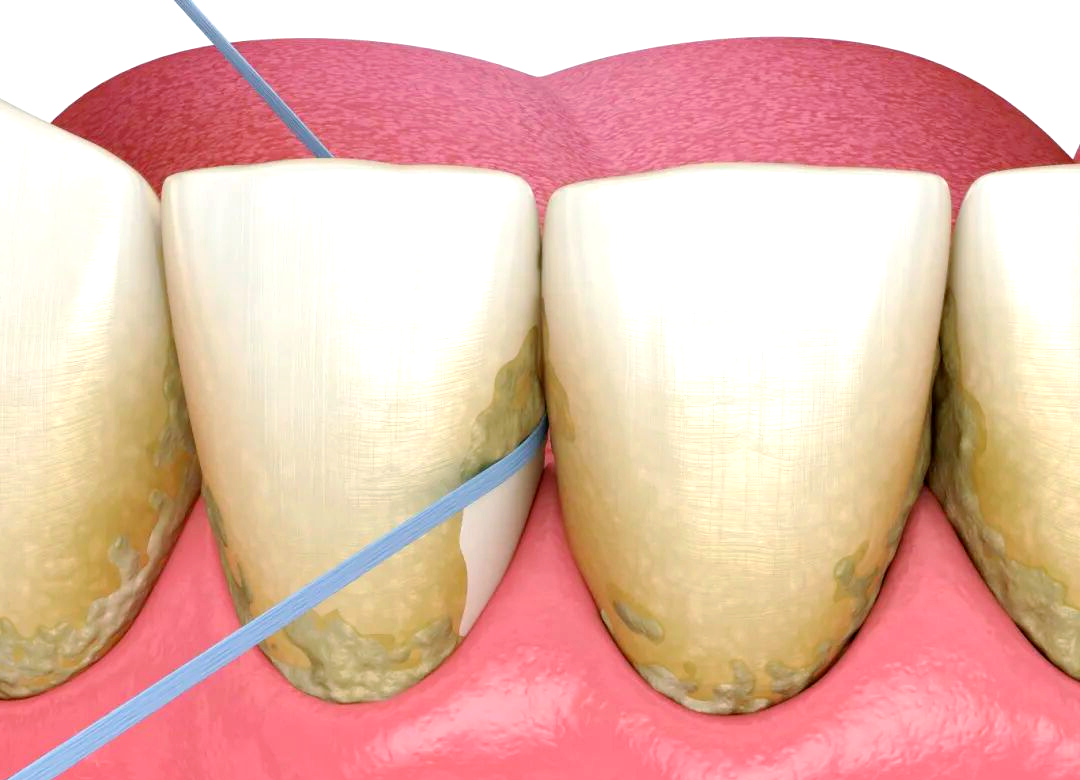 牙釉质的重要性及损伤后的防护措施