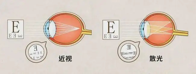 高度散光可以做近视手术吗?丽水提供4种矫正手术方法