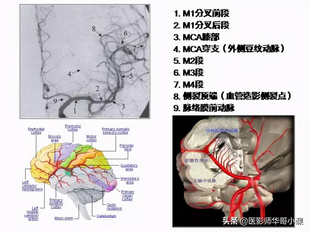 正常mra图像脑血管分段图片