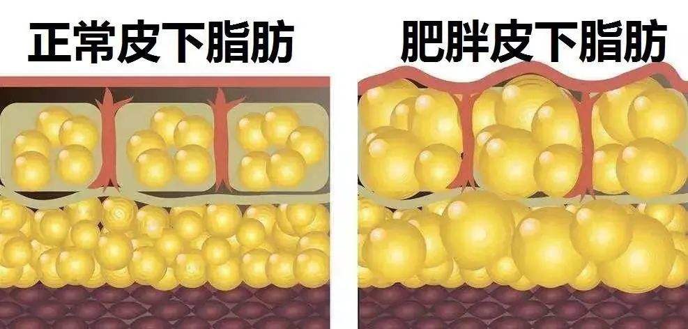 年轻男子感染新冠不幸离世,主要原因是肥胖,肥胖如何应对新冠?