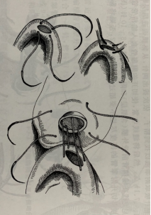 湘雅二医院泌尿外科开展显微镜下输精管附睾吻合术治疗无精子症