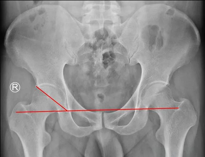 图文详解|髋关节x线测量方法与技巧详解