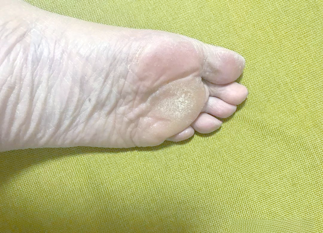 足部常见皮肤病之胼胝解析