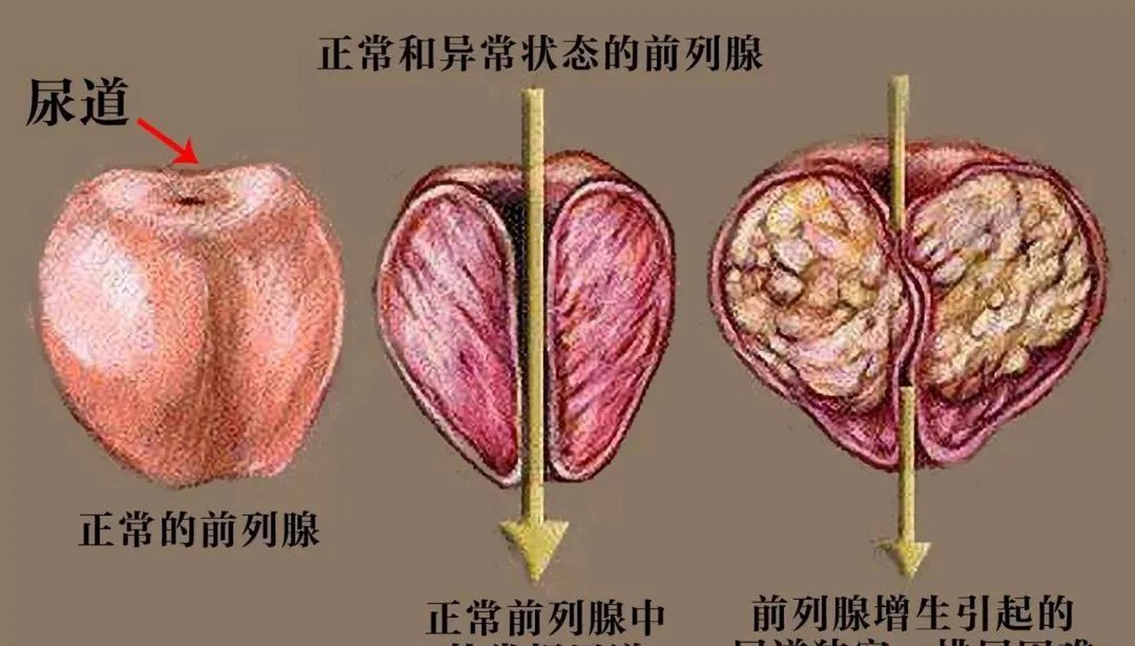 老年人前列腺增生是不是只能手术治疗?